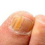 How Can You Prevent and Treat Pus Under the Toenail