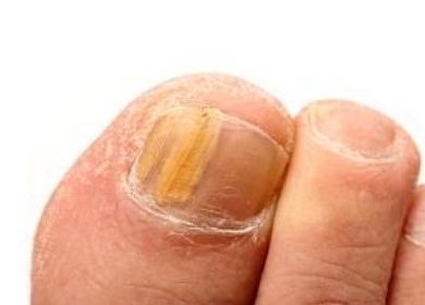 How Can You Prevent and Treat Pus Under the Toenail