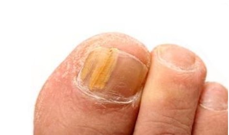 How Can You Prevent and Treat Pus Under the Toenail