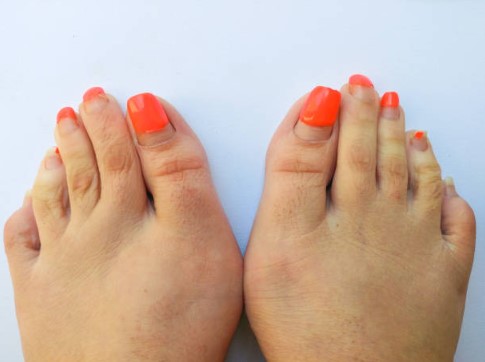 What Are The Key Advantages Of Bunionette Correction At Arizona Foot