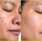 Why Choose Celibre in Torrance, CA for Age Spot Removal Services