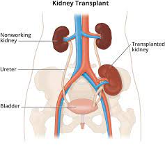 Know Latest Advances for Kidney Transplant Treatment in India