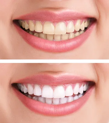 Teeth Whitening Aberdeen: Your Path to a Brighter Smile